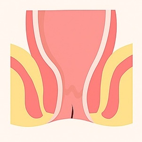 Anal Fissure