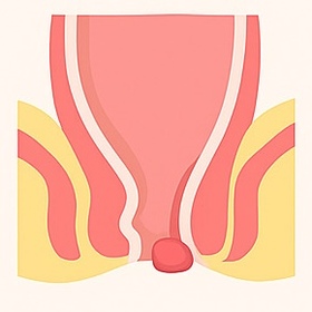 Anal Fistula